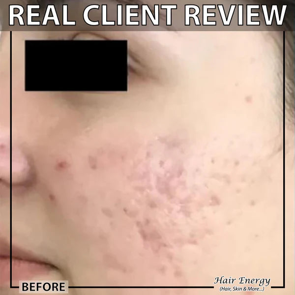 Derma Roller 0.5mm