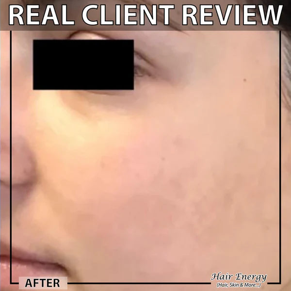 Derma Roller 0.5mm